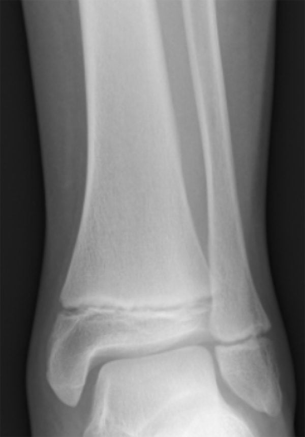 Radiographie de la cheville d'un adolescent montrant les cartilages de croissance encore ouverts, visibles sous forme de bandes sombres au bas du tibia et du péroné.