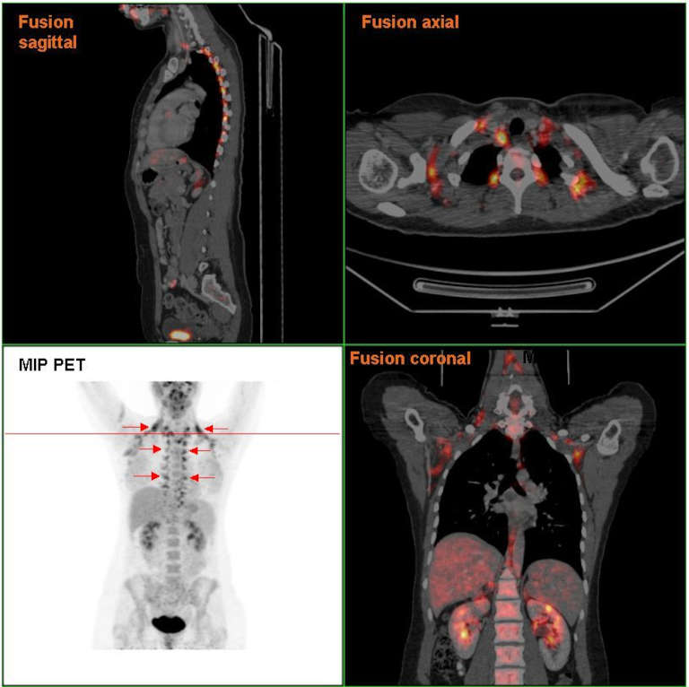 Image PET-CT montrant l'activation de la graisse brune au niveau du cou et des épaules lors d'une exposition au froid